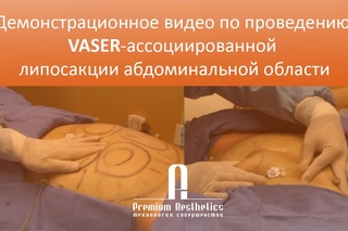 VASER липосакция